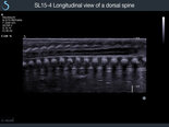 Longitudinal view of a dorsal spine Pediatrics Aixplorer SuperSonic Imagine